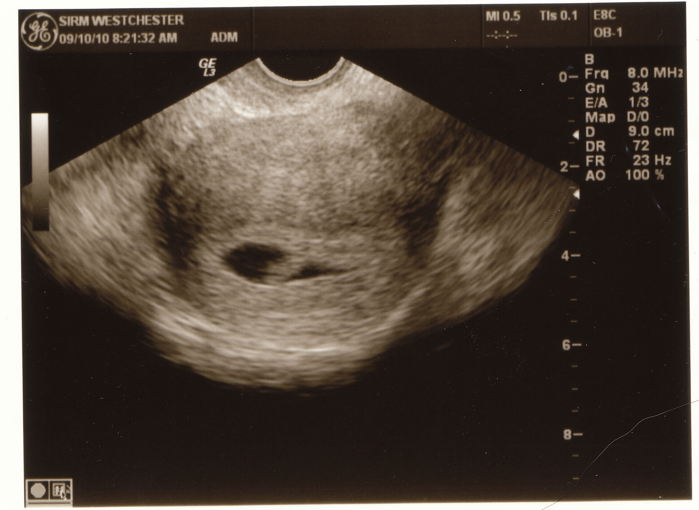 Baby Ultrasound Pictures 2